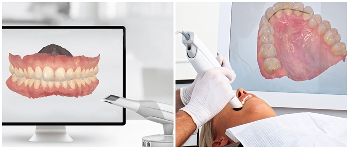 oral scanner اسکنر داخل دهانی