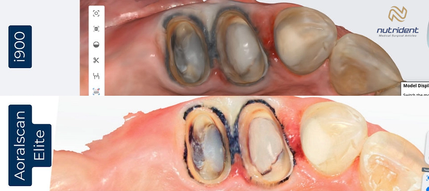 مقایسه اسکنر شاینینگ 3D با Medit i900 