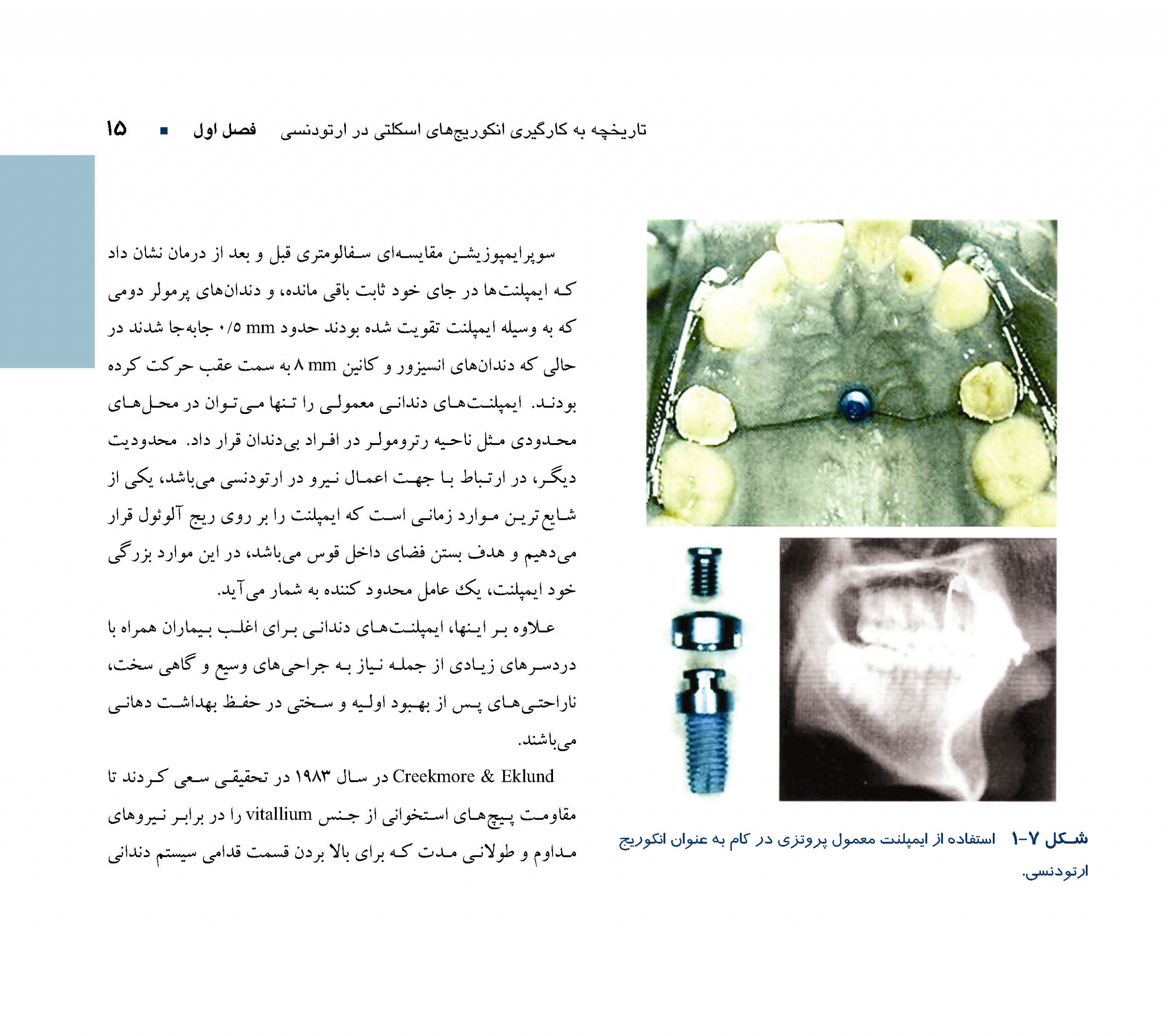 گام-به-گام-با-میکروایمپلنت_Page_14-scaled