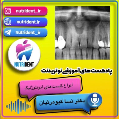 انواع کیست ادونتوژنیک
