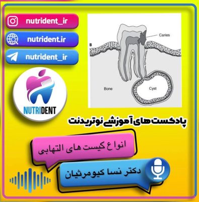 انواع کیست التهابی