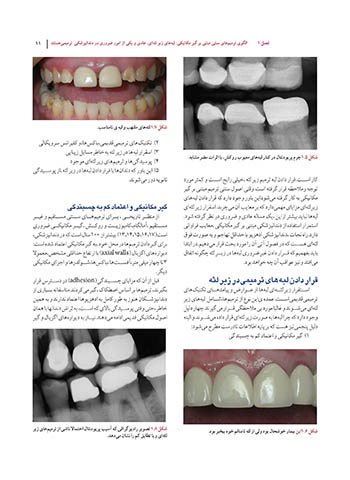 دندانپزشکی-کم-تهاجمی-فوق-لثه-ای_Page_11-scaled-min