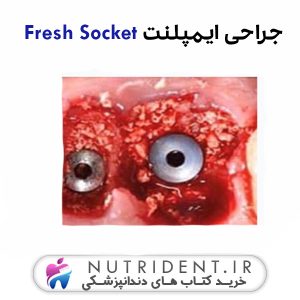 جراحی ایمپلنت Fresh Socket