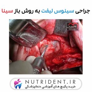 جراحی سینوس لیفت به روش باز سینا