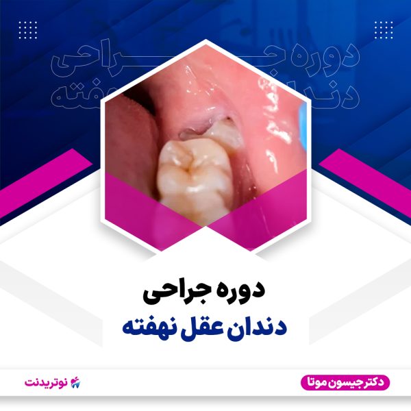 کاور دوره جراحی دندان عقل نهفته دوره جراحی دندان عقل نهفته