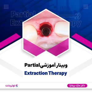 وبینار Partial Extraction Therapy