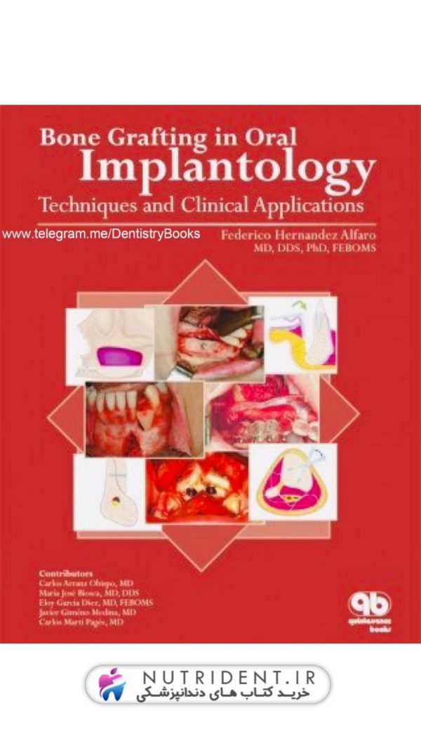bone grafting