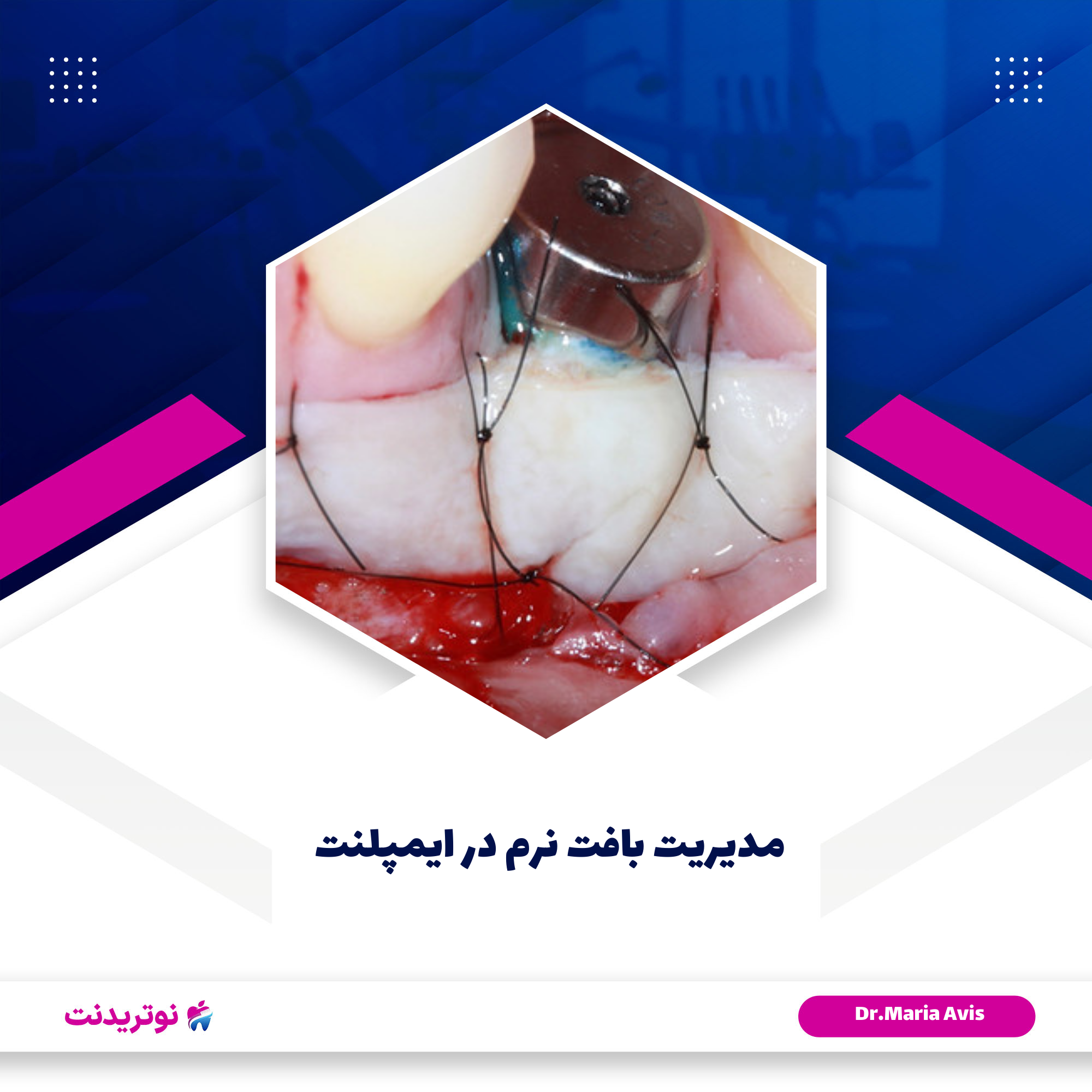 دوره آموزشی مدیریت بافت نرم در ایمپلنت