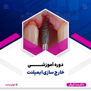 دوره آموزشی خارج‌سازی ایمپلنت