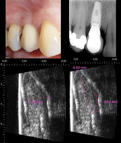 نمونه تصویربرداری داخل دهانی با استفاده از سونوگرافی دندانپزشکی