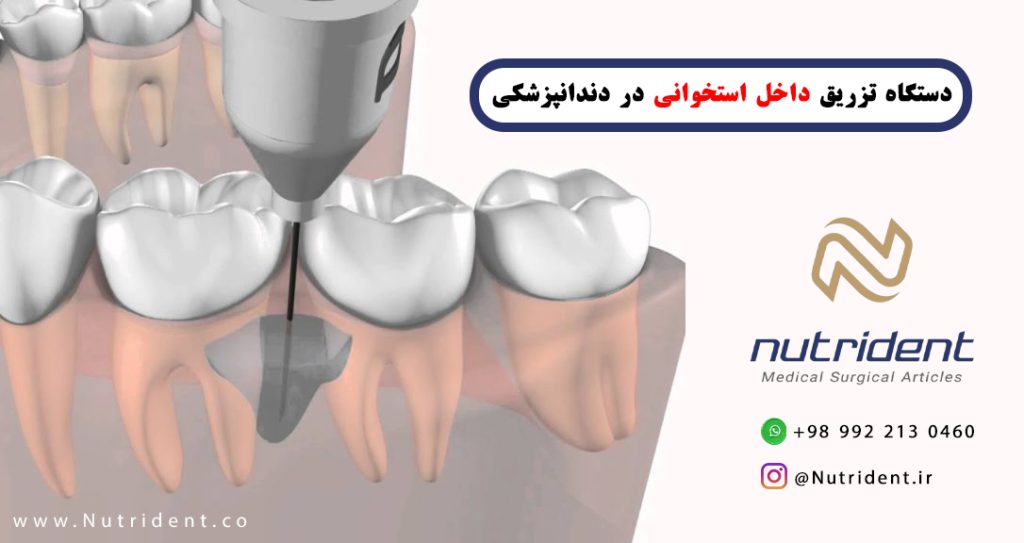 دستگاه تزریق داخل استخوانی در دندانپزشکی معرفی برندهای برتر